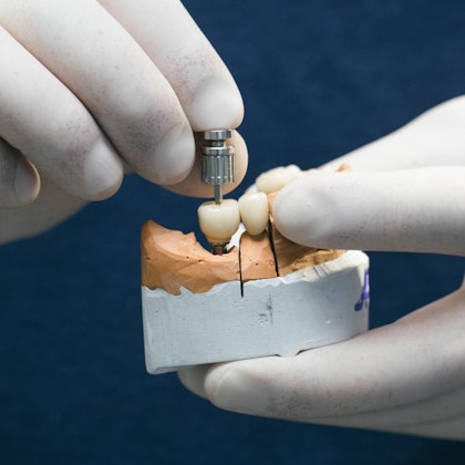 Dental implant bridge