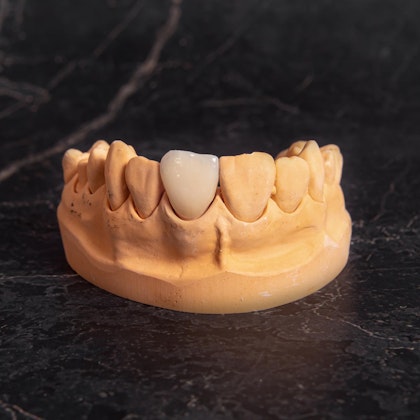 Dental crown