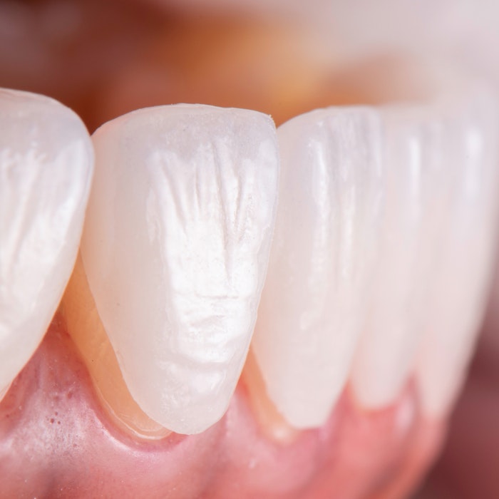 Veneers