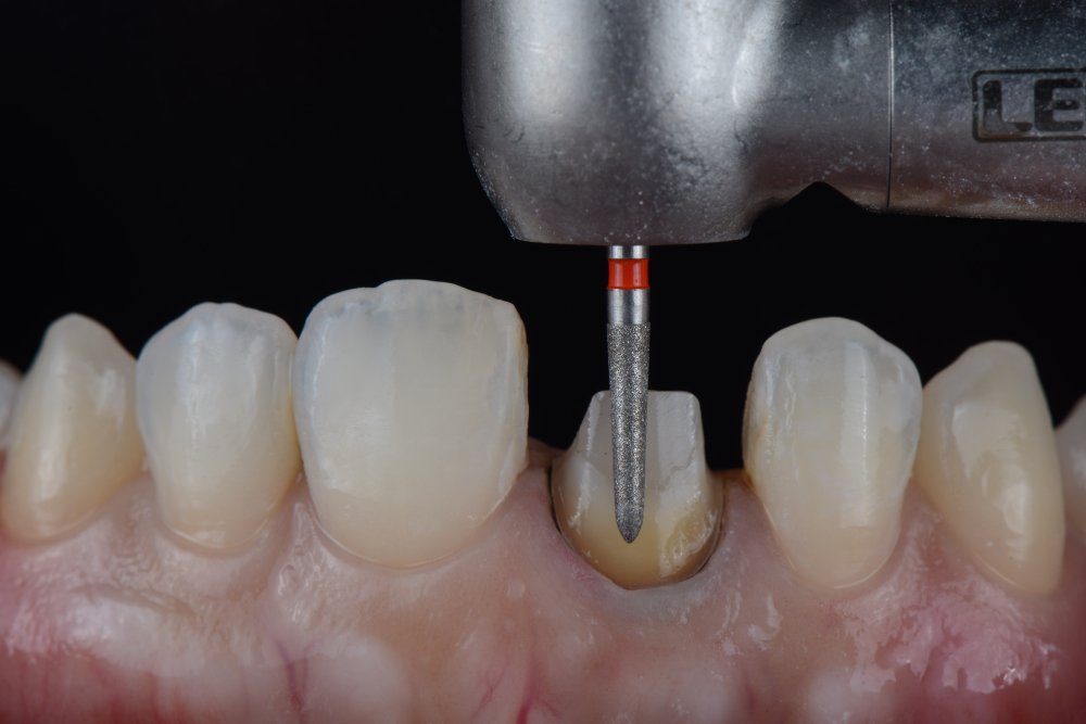 What Happens During the Dental Crown Procedure?