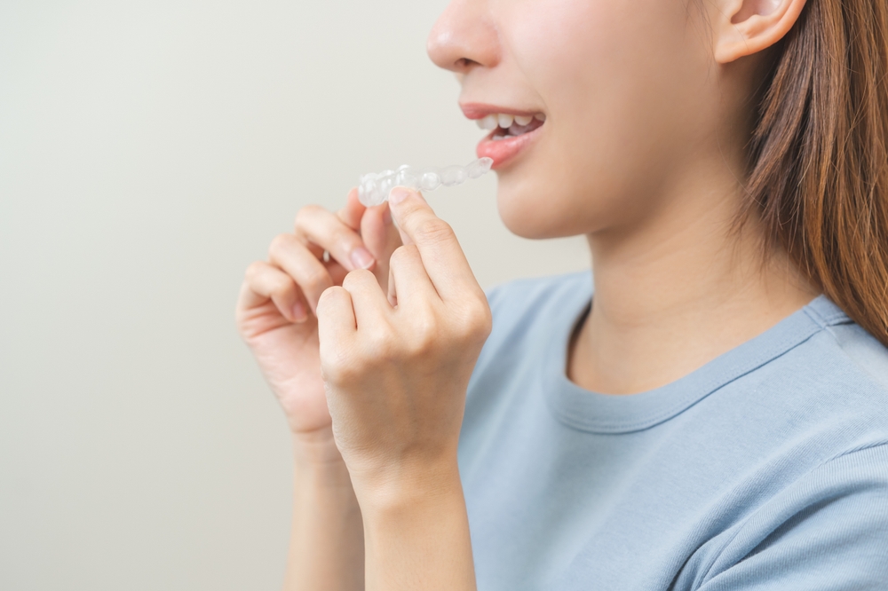 How Invisalign Aligners Gradually Shift Your Teeth Into Place
